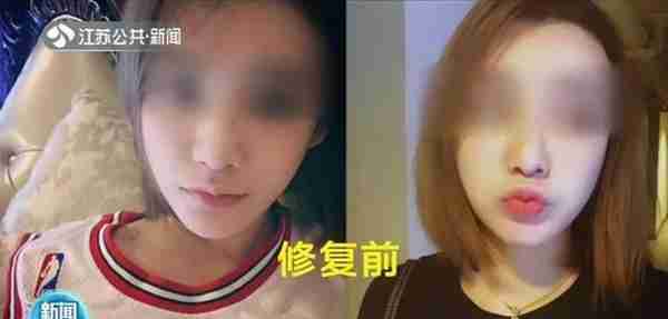 女主播花2万多做“隆鼻修复术”，整完鼻子变4个洞！更过分的是…